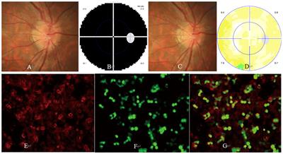 Prevalence of serum MOG antibody and AQP4 antibody in optic neuritis after SARS-CoV-2 infection